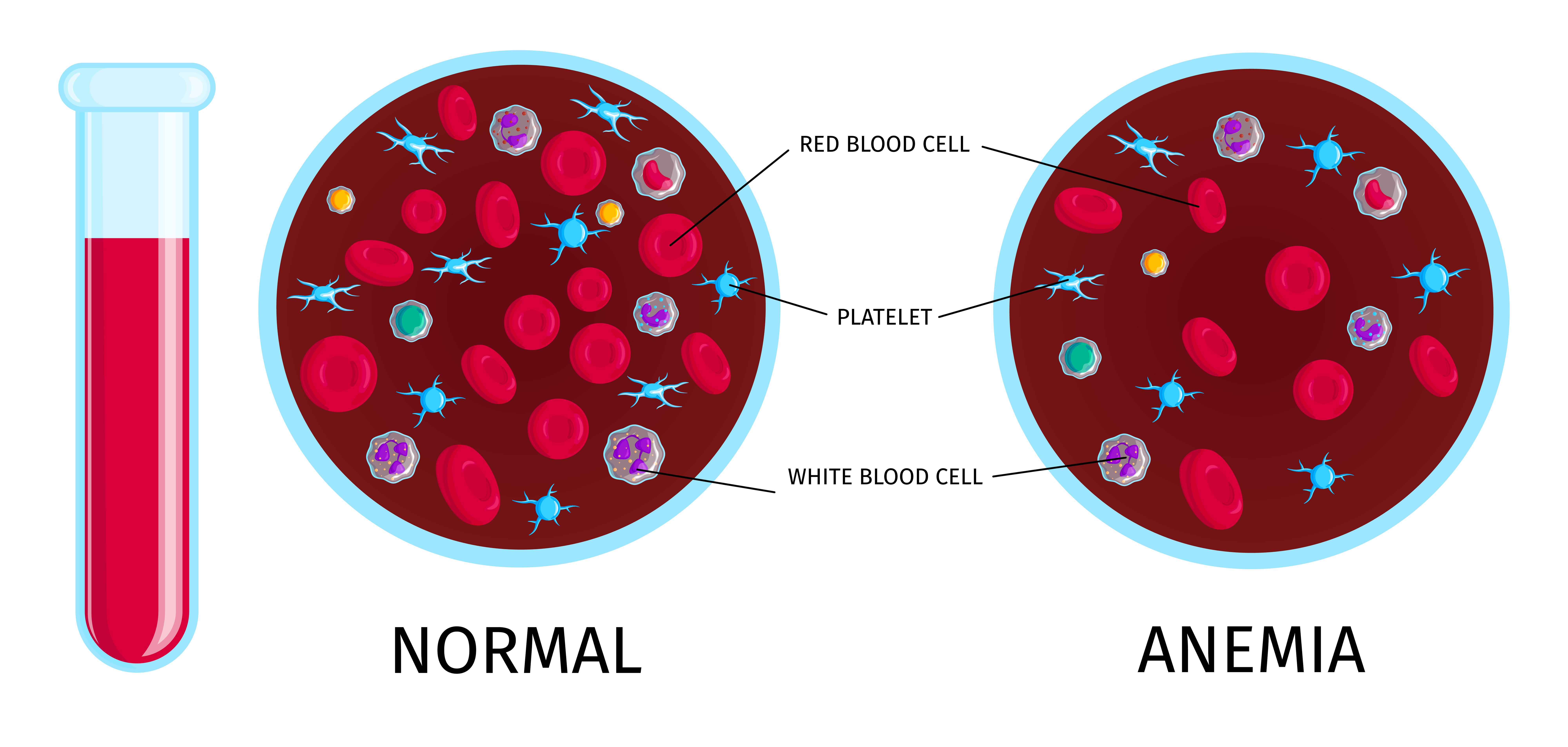 iron deficiency
