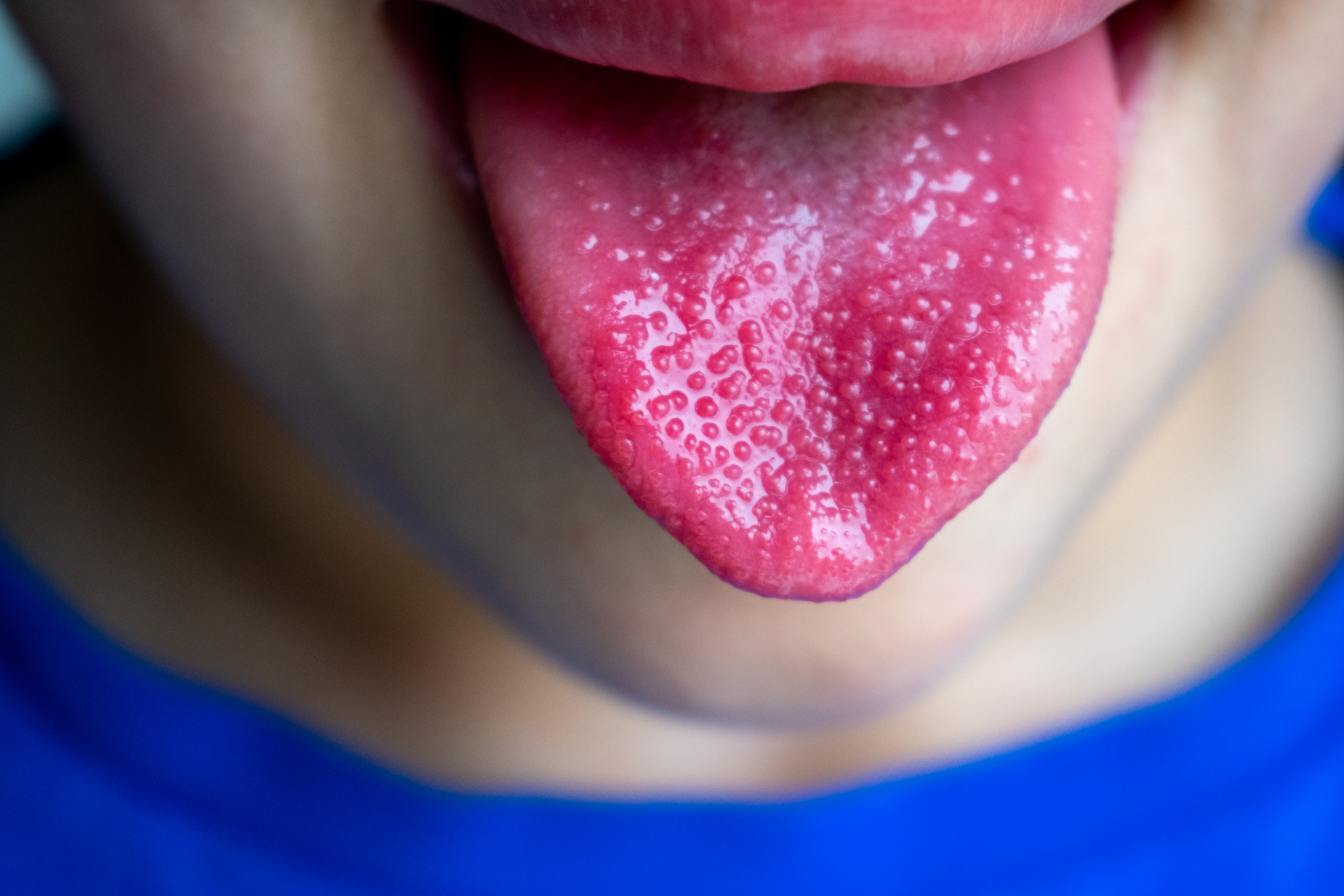 group-a-streptococcus-scarlet-fever-sore-throat-red-rash